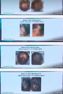 Hair Restoration Package - Morpheus8 and PRP Inj.