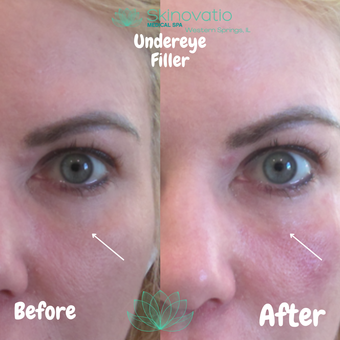 PRP Injection Bundle 