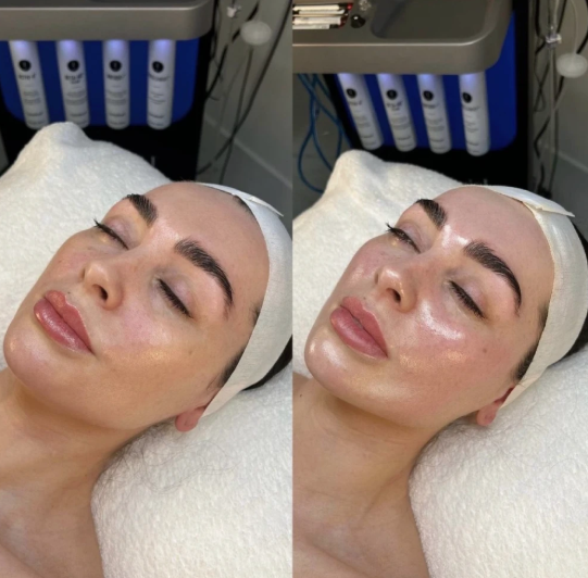 3 sessions Signature hydrafacial March Madness
