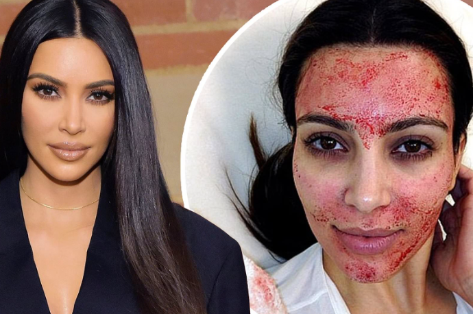 Vampire Facial (Microneedling with PRP)